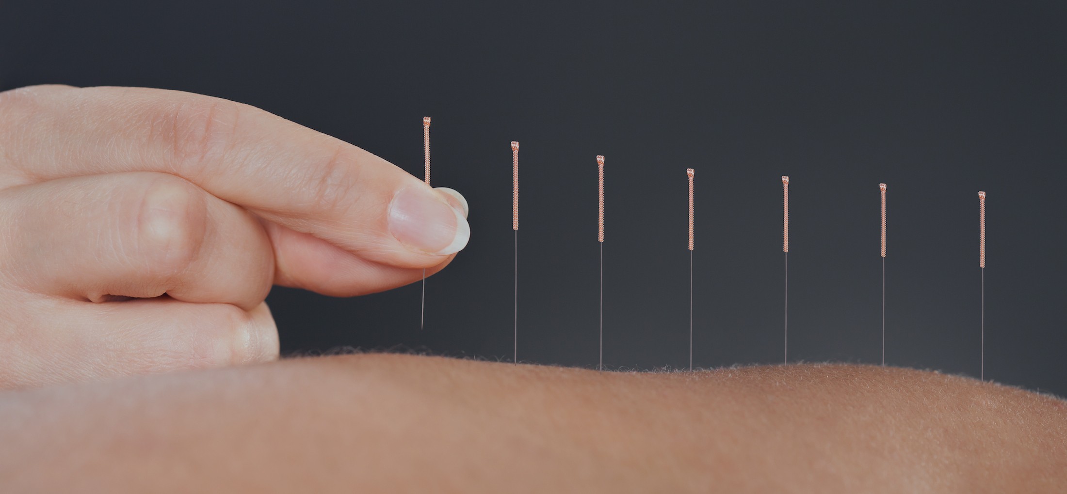 ACUPUNCTURE / TRADITIONAL CHINESE MEDICINE - Balance Complimentary Medicine