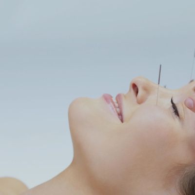 A woman getting acupuncture on her face